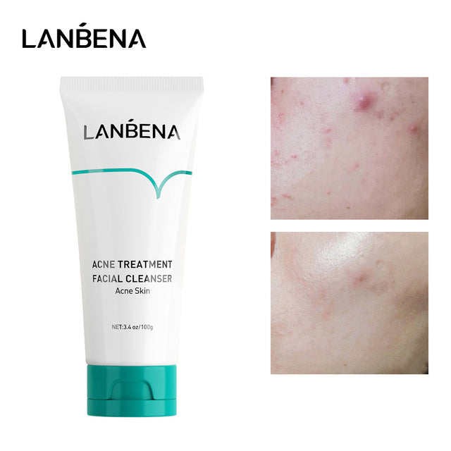 LANBENA Acne Treatment Facial Cleanser